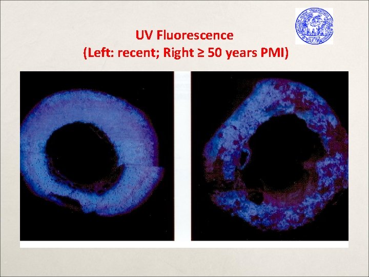 UV Fluorescence (Left: recent; Right ≥ 50 years PMI) 