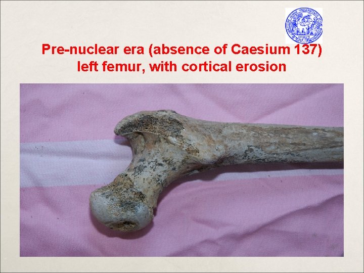 Pre-nuclear era (absence of Caesium 137) left femur, with cortical erosion 