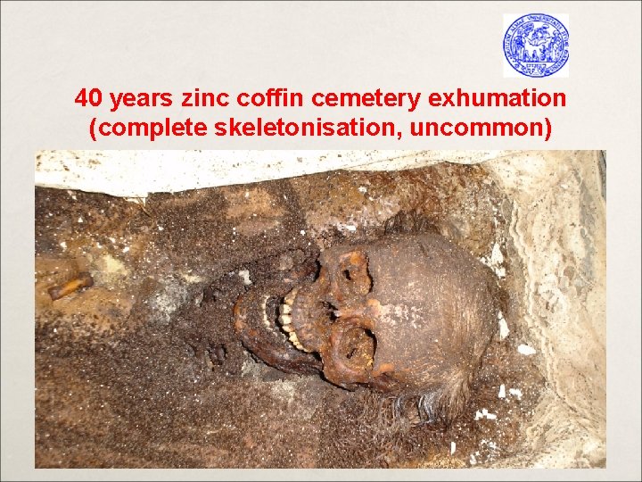 40 years zinc coffin cemetery exhumation (complete skeletonisation, uncommon) 