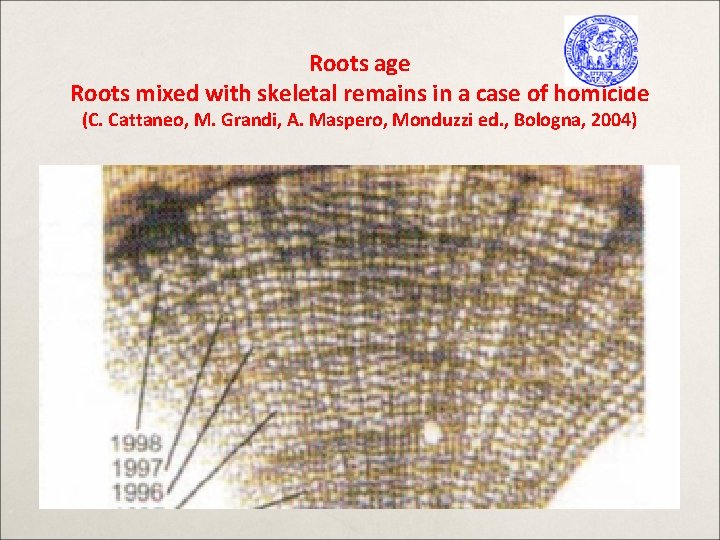 Roots age Roots mixed with skeletal remains in a case of homicide (C. Cattaneo,