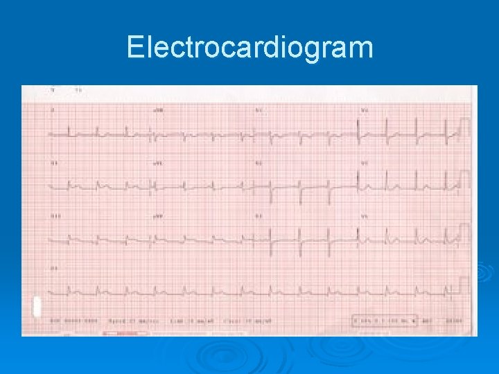 Electrocardiogram 