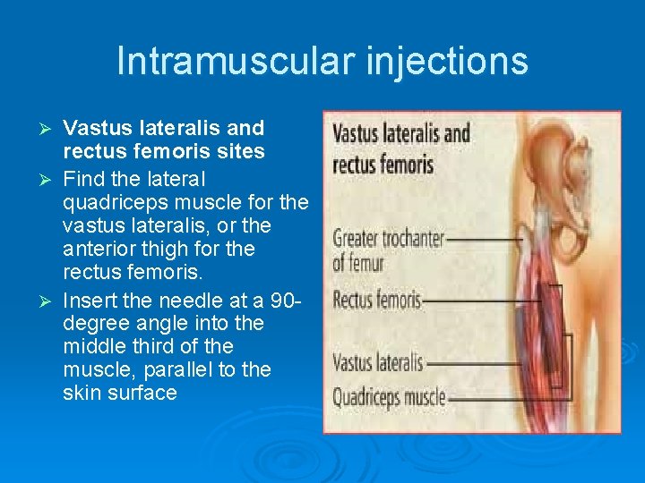 Intramuscular injections Vastus lateralis and rectus femoris sites Ø Find the lateral quadriceps muscle