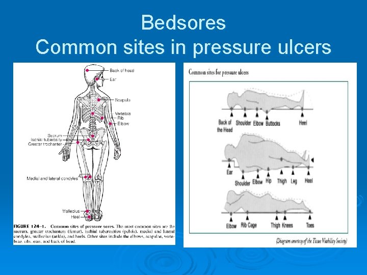 Bedsores Common sites in pressure ulcers 