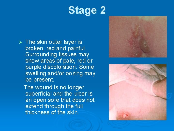 Stage 2 Ø The skin outer layer is broken, red and painful. Surrounding tissues