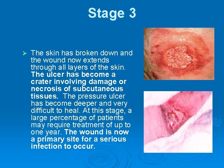 Stage 3 Ø The skin has broken down and the wound now extends through