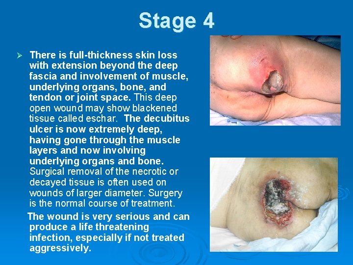 Stage 4 Ø There is full-thickness skin loss with extension beyond the deep fascia