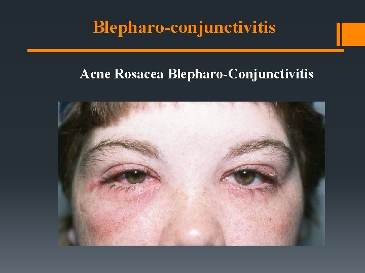 Blepharo-conjunctivitis Acne Rosacea Blepharo-Conjunctivitis Blepharo-conjunctivitis Acne Rosacea Blepharo-Conjunctivitis