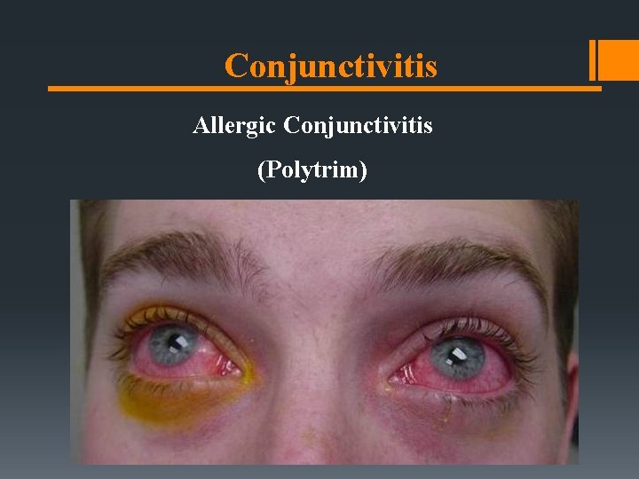 Conjunctivitis Allergic Conjunctivitis (Polytrim) Conjunctivitis Allergic Conjunctivitis (Polytrim)
