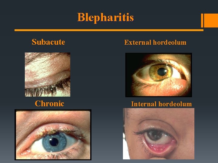 Blepharitis Subacute Chronic External hordeolum Internal hordeolum Blepharitis Subacute Chronic External hordeolum Internal hordeolum