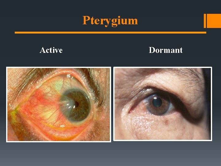 Pterygium Active Dormant Pterygium Active Dormant