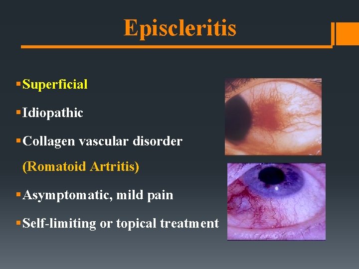 Episcleritis § Superficial § Idiopathic § Collagen vascular disorder (Romatoid Artritis) § Asymptomatic, mild Episcleritis § Superficial § Idiopathic § Collagen vascular disorder (Romatoid Artritis) § Asymptomatic, mild