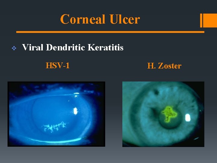 Corneal Ulcer v Viral Dendritic Keratitis HSV-1 H. Zoster Corneal Ulcer v Viral Dendritic Keratitis HSV-1 H. Zoster