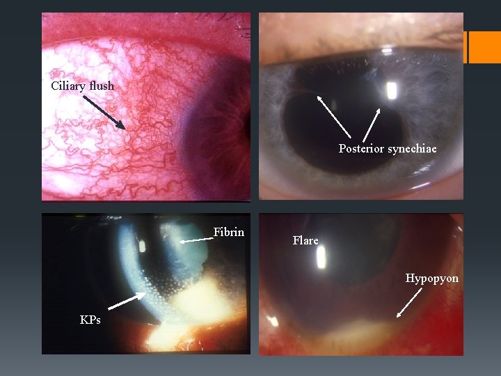 Ciliary flush Posterior synechiae Fibrin Flare Hypopyon KPs Ciliary flush Posterior synechiae Fibrin Flare Hypopyon KPs