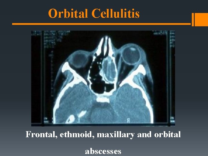 Orbital Cellulitis Frontal, ethmoid, maxillary and orbital abscesses Orbital Cellulitis Frontal, ethmoid, maxillary and orbital abscesses