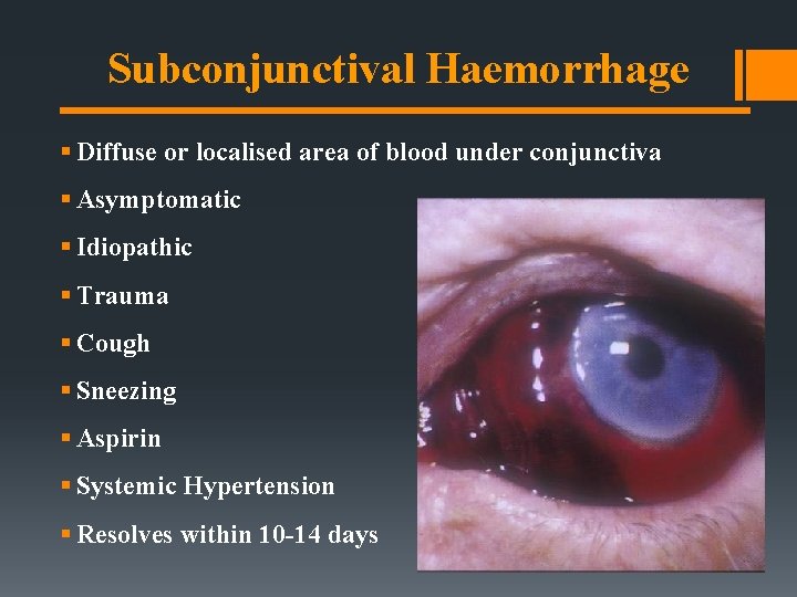 Subconjunctival Haemorrhage § Diffuse or localised area of blood under conjunctiva § Asymptomatic § Subconjunctival Haemorrhage § Diffuse or localised area of blood under conjunctiva § Asymptomatic §