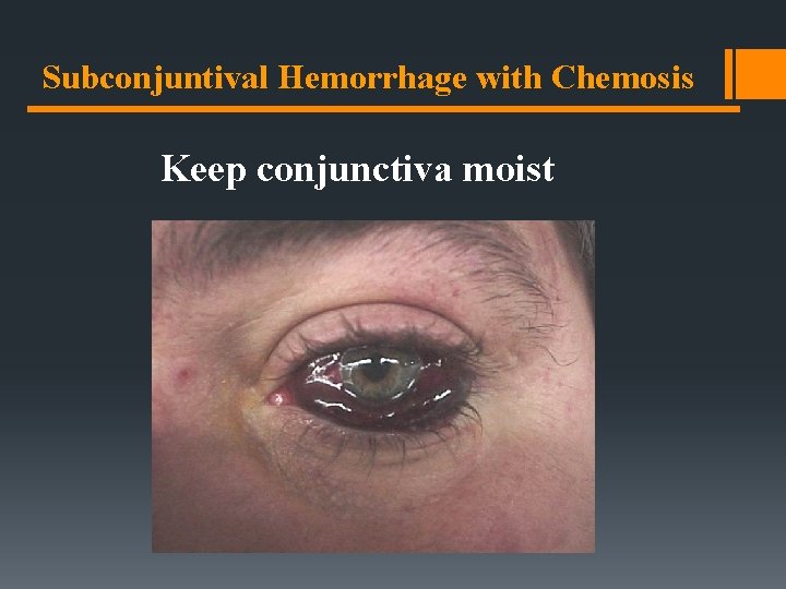 Subconjuntival Hemorrhage with Chemosis Keep conjunctiva moist Subconjuntival Hemorrhage with Chemosis Keep conjunctiva moist