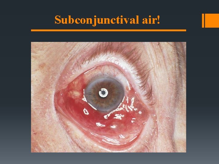 Subconjunctival air! Subconjunctival air!