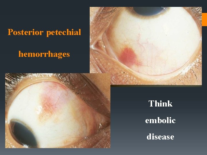 Posterior petechial hemorrhages Think embolic disease Posterior petechial hemorrhages Think embolic disease