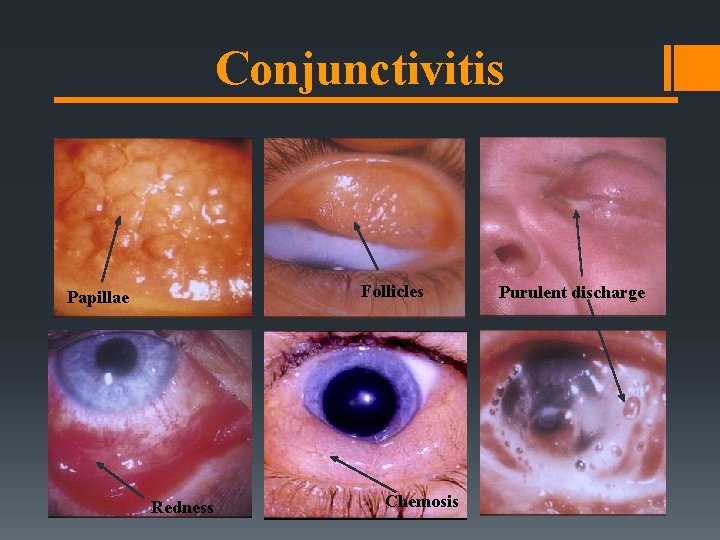 Conjunctivitis Follicles Papillae Redness Chemosis Purulent discharge Conjunctivitis Follicles Papillae Redness Chemosis Purulent discharge