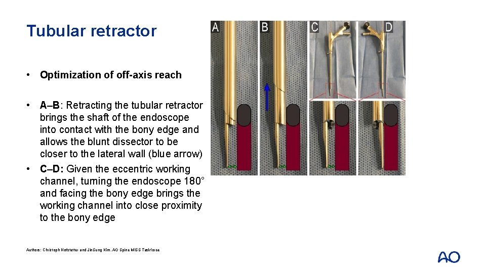 Tubular retractor • Optimization of off-axis reach • A–B: Retracting the tubular retractor brings