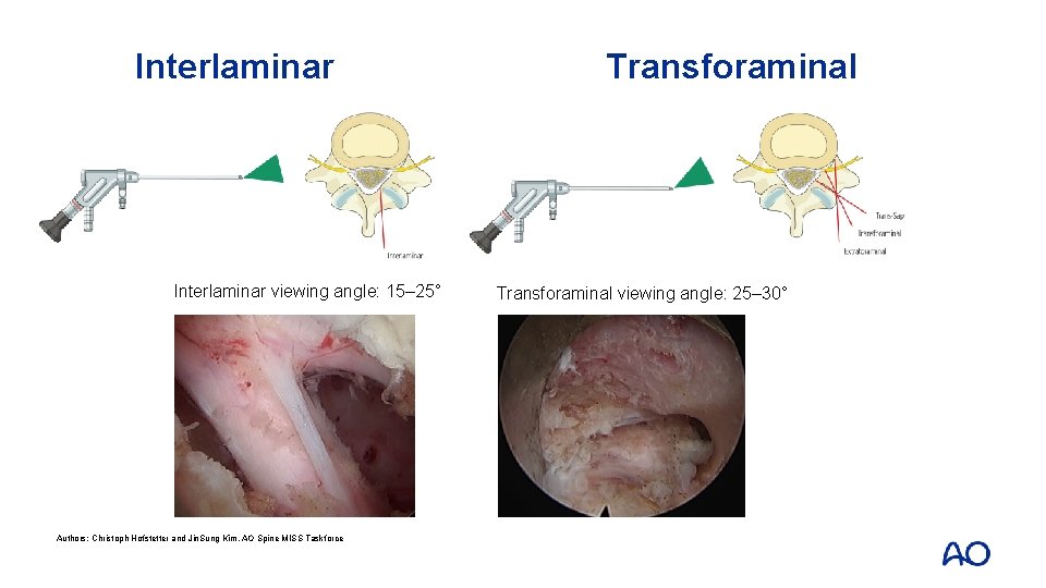 Interlaminar viewing angle: 15– 25° Authors: Christoph Hofstetter and Jin. Sung Kim, AO Spine