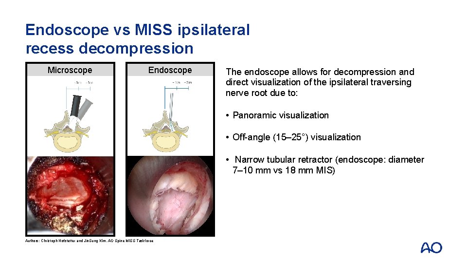 Endoscope vs MISS ipsilateral recess decompression Microscope Endoscope The endoscope allows for decompression and