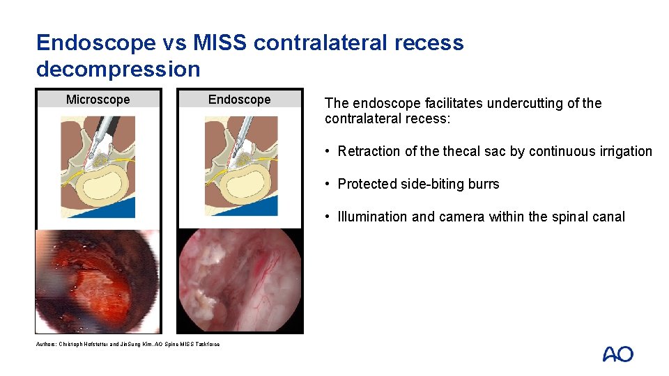 Endoscope vs MISS contralateral recess decompression Microscope Endoscope The endoscope facilitates undercutting of the