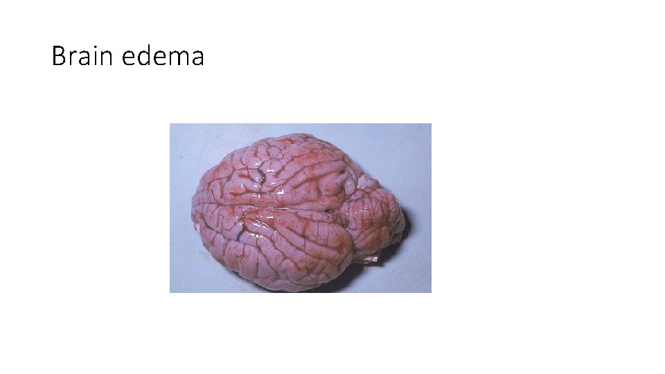 Brain edema 