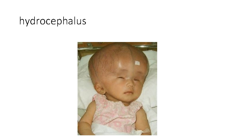 hydrocephalus 