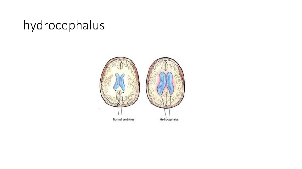 hydrocephalus 