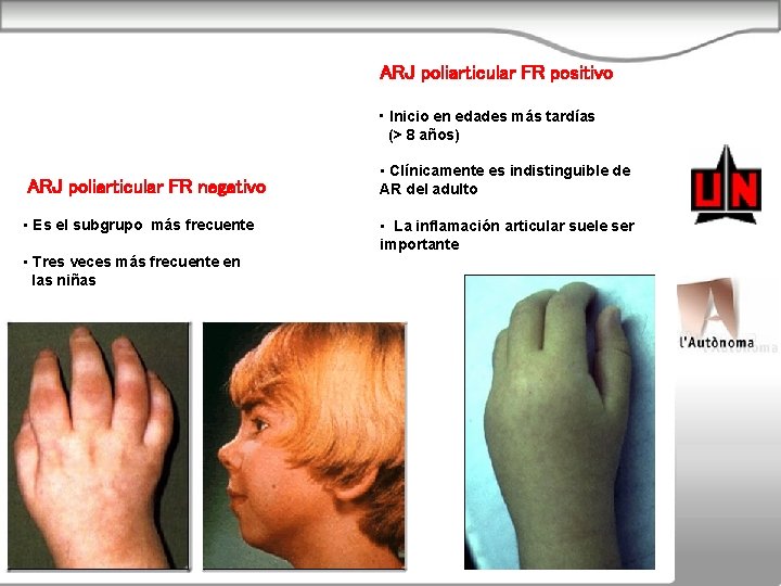 ARJ poliarticular FR positivo • Inicio en edades más tardías (> 8 años) ARJ