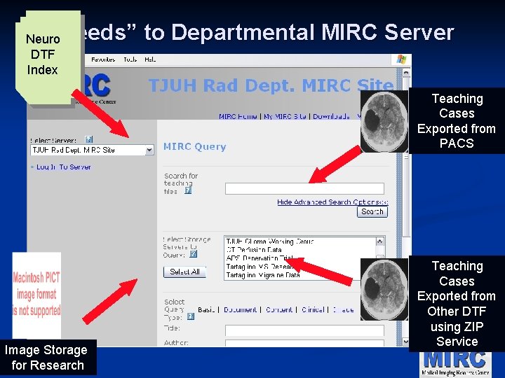 “Feeds” to Departmental MIRC Server Neuro DTF Index Teaching Cases Exported from PACS Image