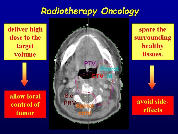 Radiotherapy Oncology spare the surrounding healthy tissues. deliver high dose to the target volume