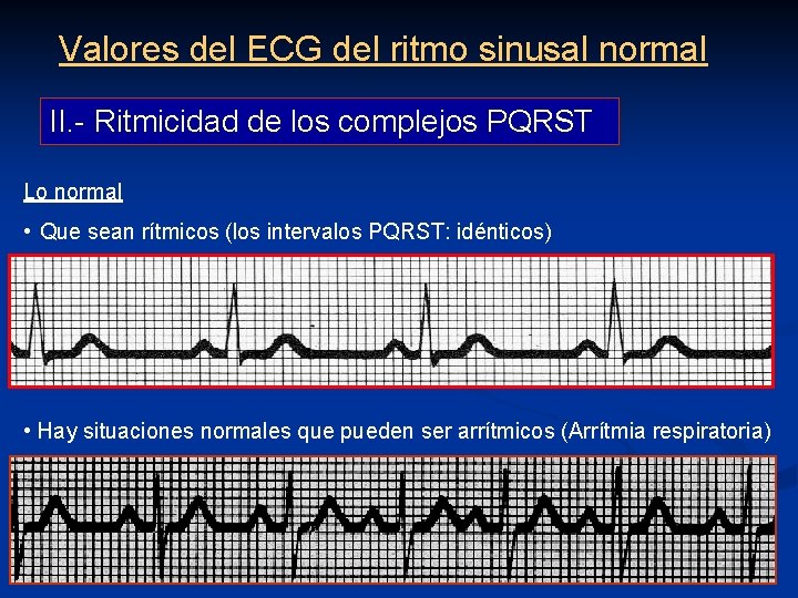 Valores del ECG del ritmo sinusal normal II. - Ritmicidad de los complejos PQRST