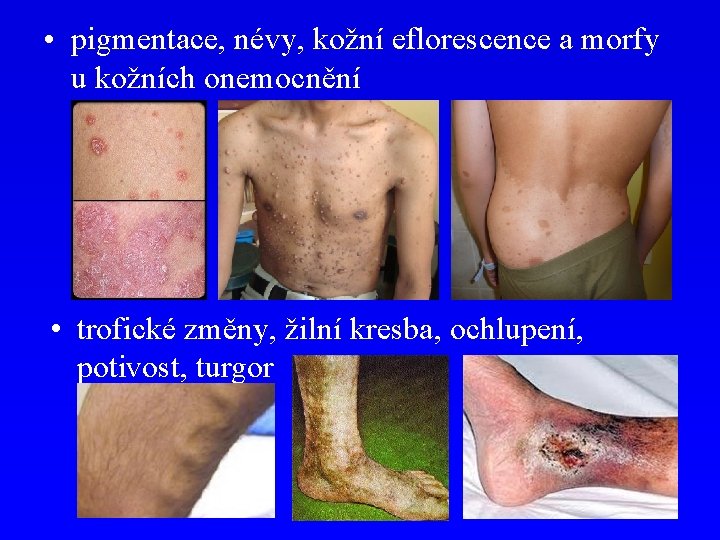  • pigmentace, névy, kožní eflorescence a morfy u kožních onemocnění • trofické změny,