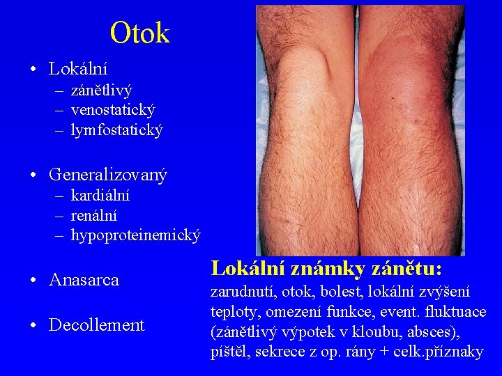 Otok • Lokální – zánětlivý – venostatický – lymfostatický • Generalizovaný – kardiální –