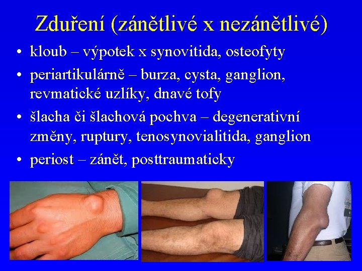 Zduření (zánětlivé x nezánětlivé) • kloub – výpotek x synovitida, osteofyty • periartikulárně –