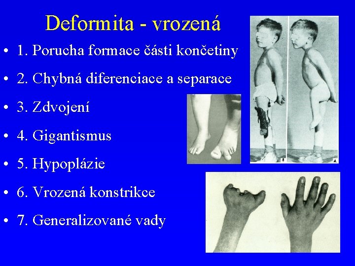 Deformita - vrozená • 1. Porucha formace části končetiny • 2. Chybná diferenciace a