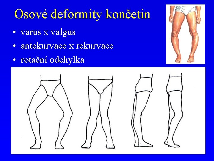 Osové deformity končetin • varus x valgus • antekurvace x rekurvace • rotační odchylka