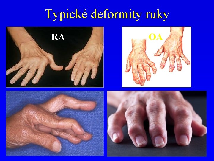 Typické deformity ruky RA OA 