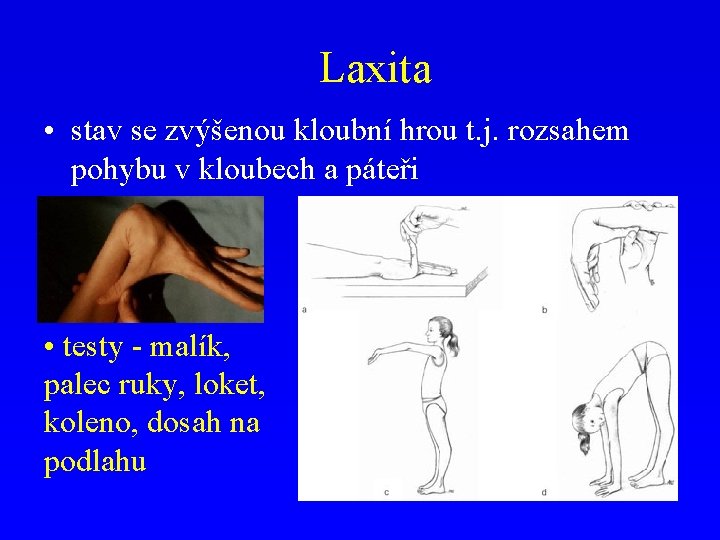 Laxita • stav se zvýšenou kloubní hrou t. j. rozsahem pohybu v kloubech a