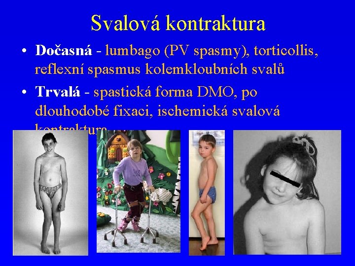 Svalová kontraktura • Dočasná - lumbago (PV spasmy), torticollis, reflexní spasmus kolemkloubních svalů •