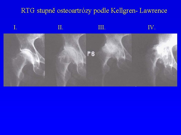 RTG stupně osteoartrózy podle Kellgren- Lawrence I. III. IV. 