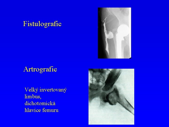 Fistulografie Artrografie Velký invertovaný limbus, dichotomická hlavice femuru 