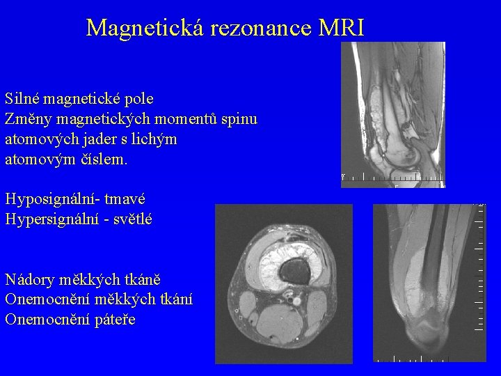 Magnetická rezonance MRI Silné magnetické pole Změny magnetických momentů spinu atomových jader s lichým