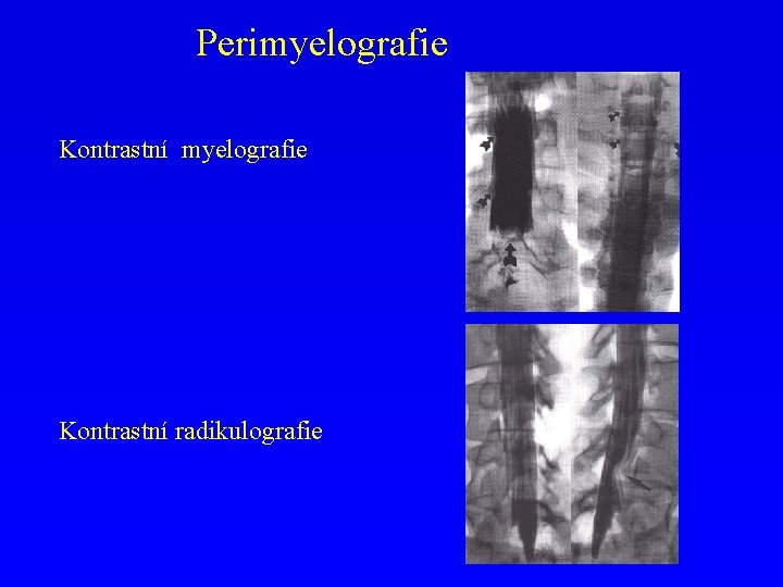 Perimyelografie Kontrastní radikulografie 