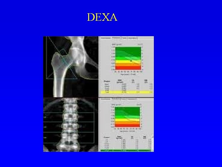 DEXA 