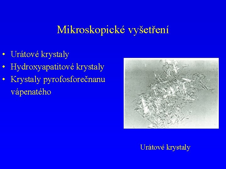 Mikroskopické vyšetření • Urátové krystaly • Hydroxyapatitové krystaly • Krystaly pyrofosforečnanu vápenatého Urátové krystaly