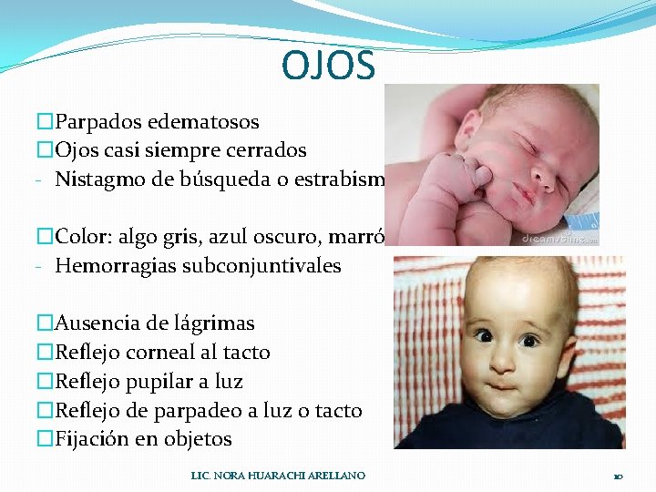 OJOS �Parpados edematosos �Ojos casi siempre cerrados - Nistagmo de búsqueda o estrabismo �Color: