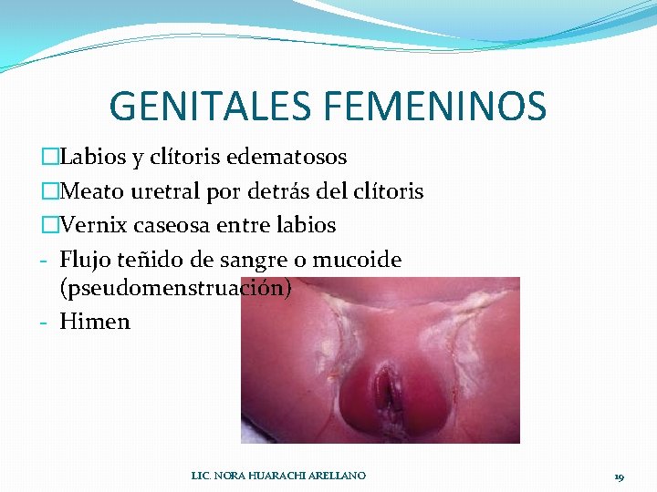 GENITALES FEMENINOS �Labios y clítoris edematosos �Meato uretral por detrás del clítoris �Vernix caseosa